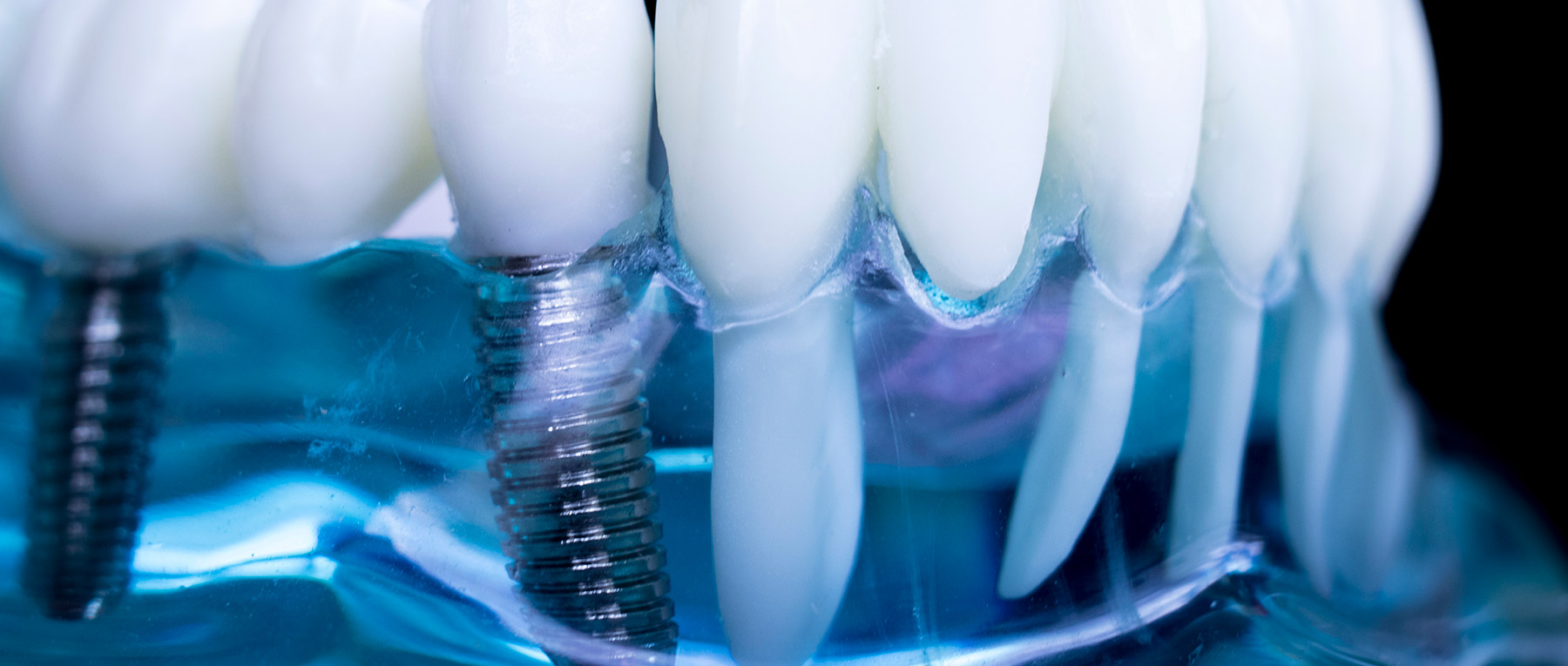 impianti dentali Brescia