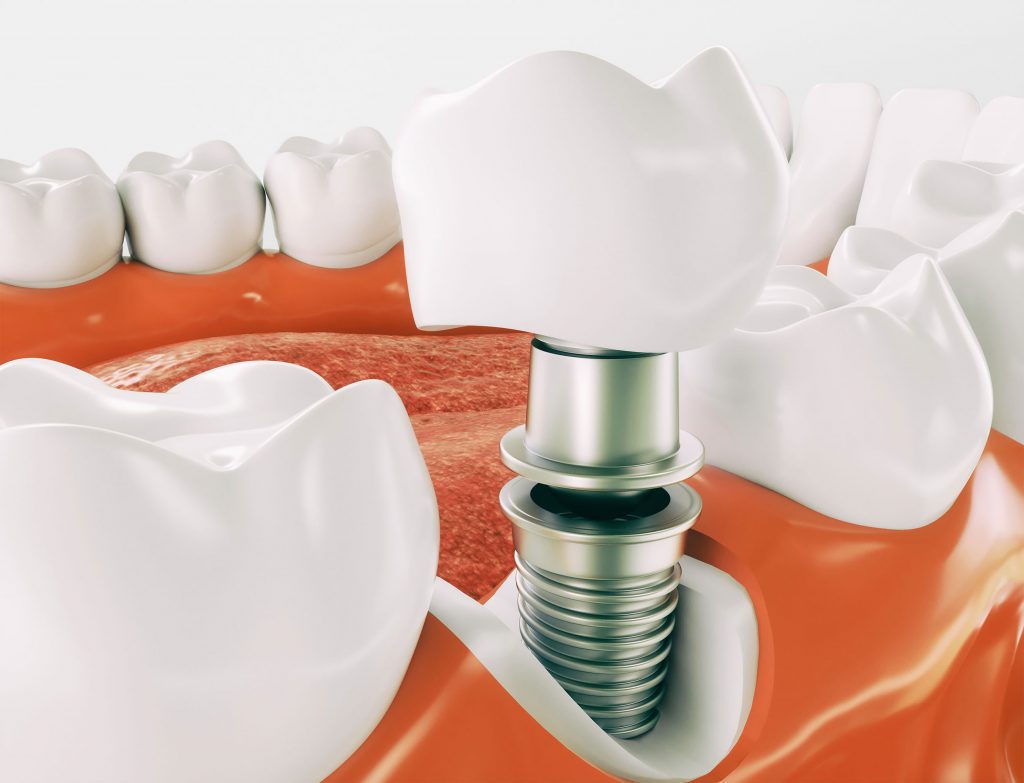 dentista implantologia brescia